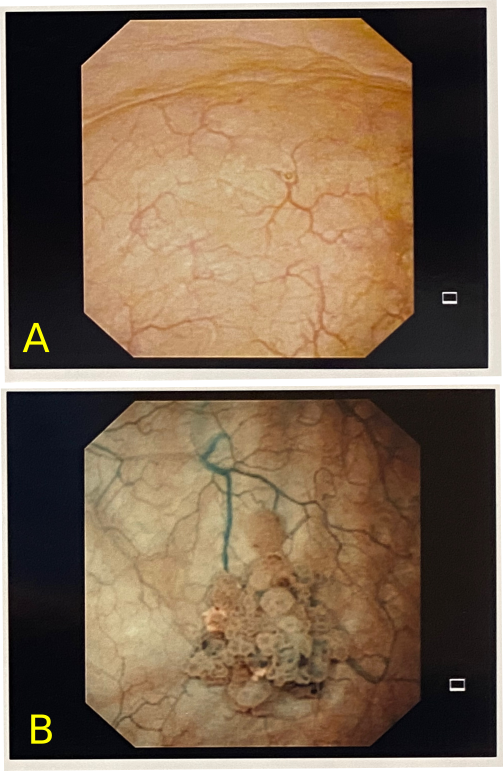 Image of Bladder Cancer