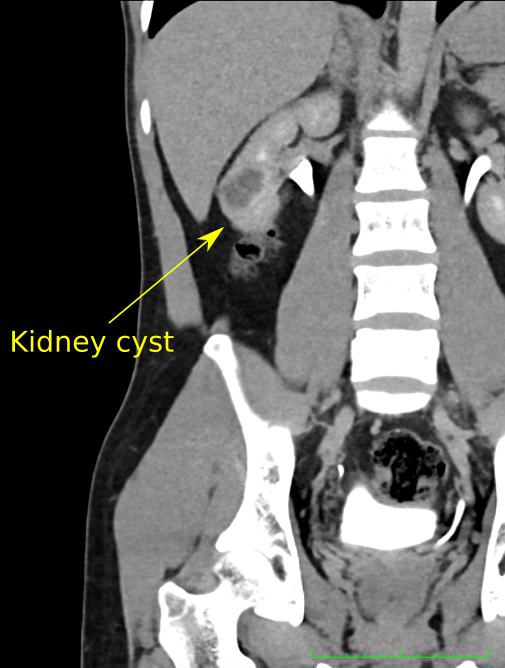 Simple And Complex Renal Cysts In Adults: Classification, 56% OFF